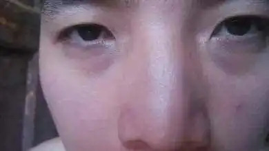 看眼袋测疾病隐患脾虚还是肾虚
