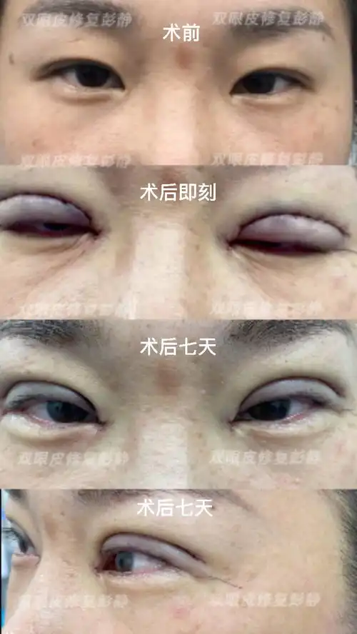 埋线双眼皮修复
