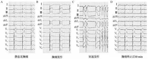 表情变异型心绞痛的心电图特征变异型心绞痛心电图特征表情
