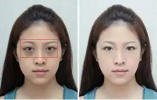 黑眼圈可以做手术吗盘点去除黑眼圈的手术方法
