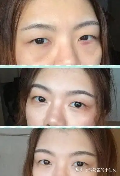请问,想在广州做去眼袋的手术,哪一家医院会好一点呢一般都多少钱

