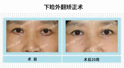 做祛眼袋手术会下睑外翻吗
