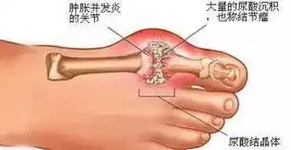痛风,不是一种病,是一串病号称生命第一痛
