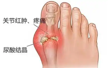 痛风是如何进展的这就是你问的高尿酸为什么没有痛风发作
