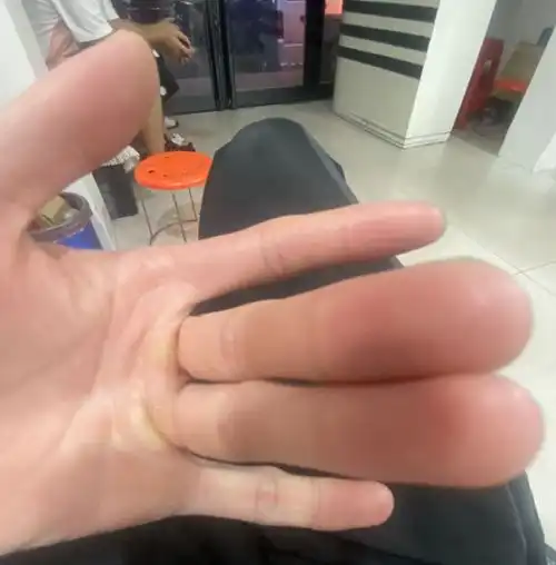 我的手咋莫名肿成这样了真心替你感到心疼哈哈哈快去医院
