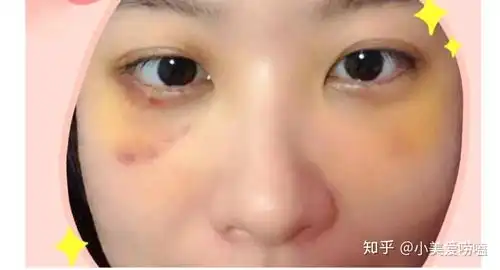 去眼袋手术恢复过程图记录我如何战胜去眼袋的后遗症,每一张都是高清图片
