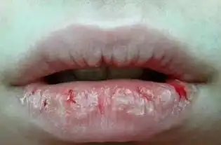 关于痘痘的常识
