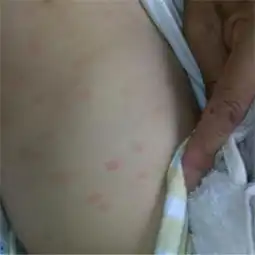 身上起红疙瘩很痒蜕皮怎么办
