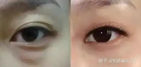 内路祛眼袋第4天图片伤口崩开天啊内吸祛眼袋后注意事项

