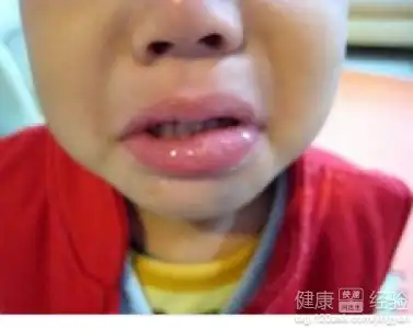 教你四招治疗口腔溃疡
