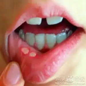 关注口腔溃疡及时用药治疗
