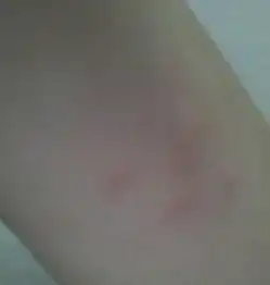 身上起包有点硬还很痒是不是蚊子咬的怎么消
