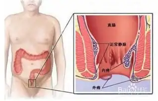 如何判断自己是否有痔疮

