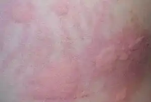 立冬了,特别注意寒冷性荨麻疹