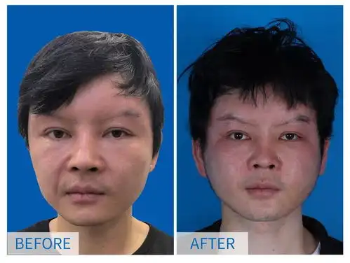 整形医生辟谣做一次拉皮手术不会损失20的表情
