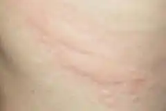 荨麻疹图片和症状