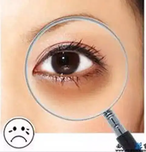 黑眼圈不光是因为肾虚哦
