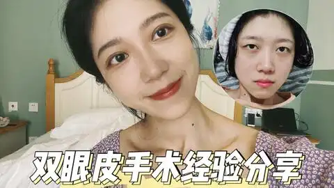 埋线双眼皮手术记录状况
