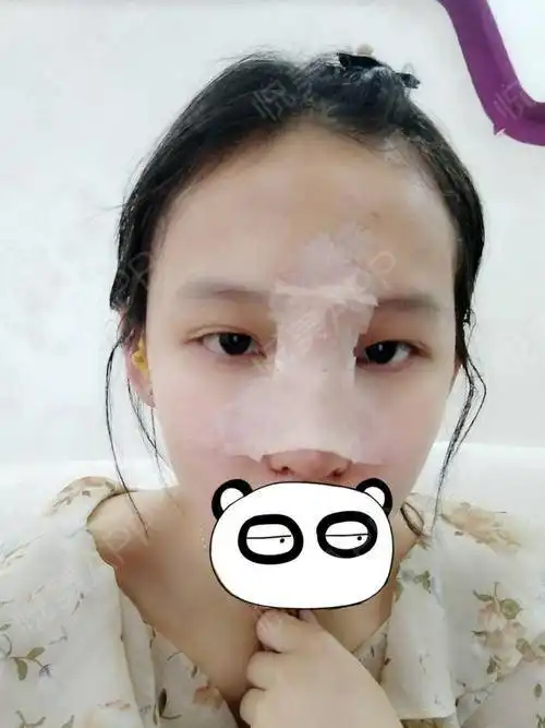 术后第二天,今天去医院去...鼻部多项悦美整形
