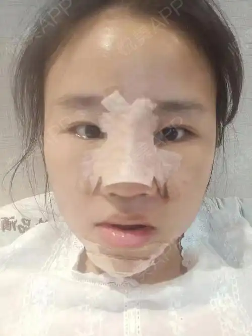 术后五天啦,刚开始做完的时候很没有习惯鼻子这样被包...垫鼻尖悦美整形
