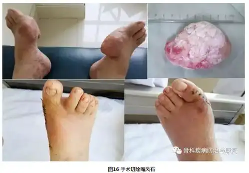 痛风转载