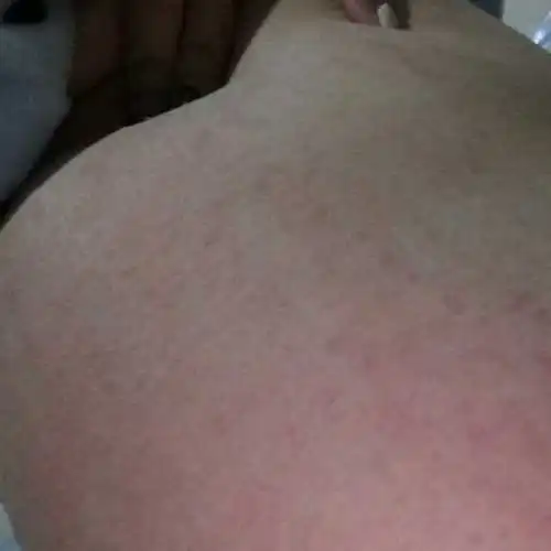 身上痒,一抓起来就起红点点
