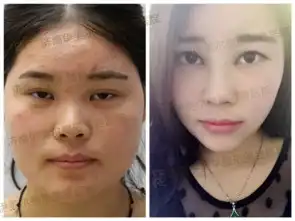 botox瘦脸轻松拥有瓜子脸
