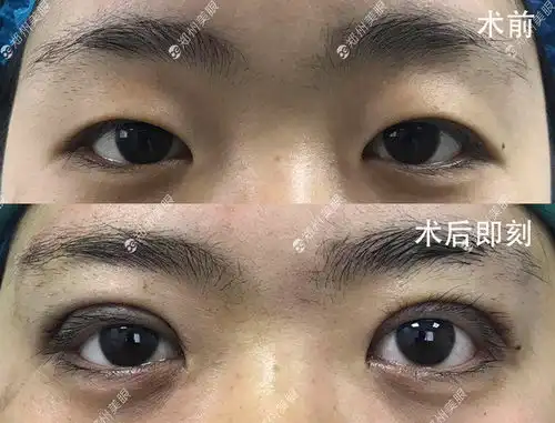 双眼皮手术去哪里好术前术后田氏双眼皮案例
