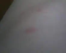 最近天气不算热,但身上莫名起了好多像咬子咬的小包,又痒又红,请问这是什么呀,有什么办法可以消除
