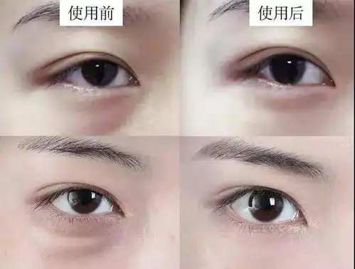 马应龙又搞事不手术也能去眼袋堪比整容的眼膜礼盒,买它
