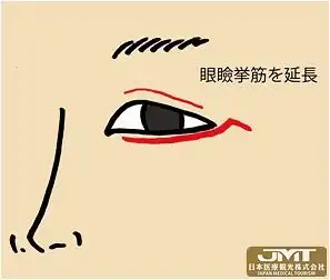 jmt日本看病面神经麻痹的治疗和重建
