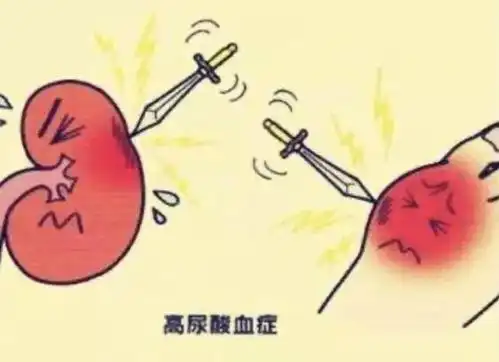 得了高尿酸血症,怎样管理饮食
