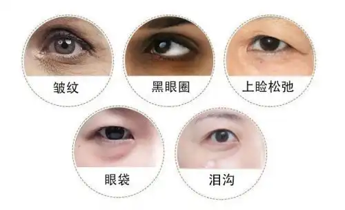 眼周衰老不要慌,天津联合丽格教你正确的有效抗衰方法
