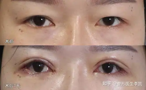 眼综合科普吊梢眼做双眼皮开眼角开挂
