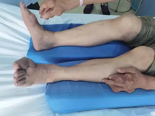 关于痛风石的护理,你了解多少
