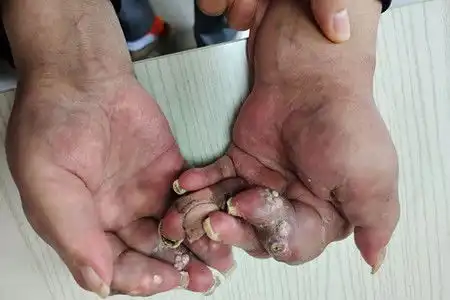 关于痛风石,你想了解的都在这里了
