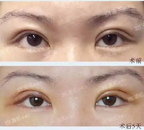 双眼皮双眼皮手术科普眼皮厚眼睛肿的原因是去脂肪就一定能解决问题吗

