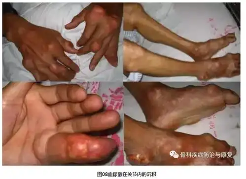 痛风转载
