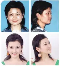 泉州瘦脸手术价格高吗
