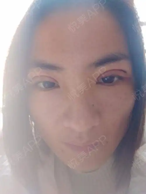 大多数手术的拆线都是一周后,到时候得去医院拆线去...眼综合整形悦美整形
