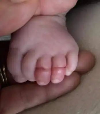 妈妈的疏忽害孩子小手肿成茄子,这种养娃疏忽危害大,谁也不要犯

