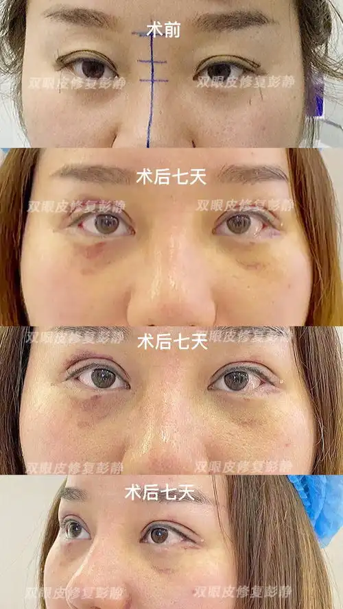 多重眼皮,左右大小眼,全切双眼皮改善
