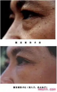 南京手术去眼袋好吗
