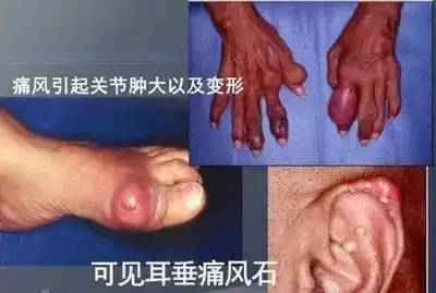 马黛双调茶痛风者的福音
