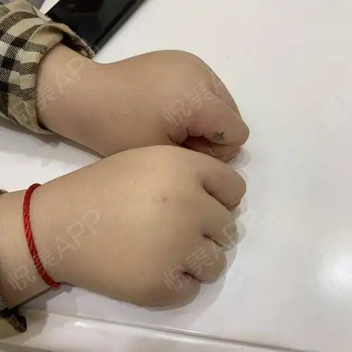 妈呀,到今天这双手肿得跟大猪蹄子一样,给我吓...面部填充悦美整形

