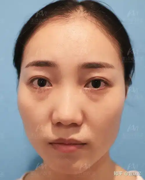 19岁女大一学生眼袋黑眼圈较重怎么办
