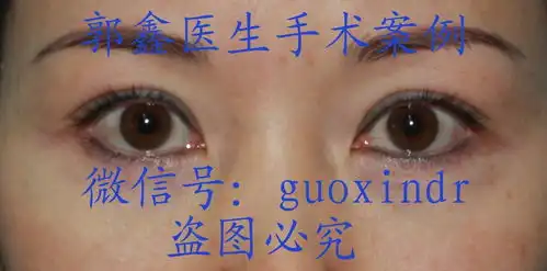 郭鑫医生手术上眼睑提升切眉术鱼尾纹去除术案例
