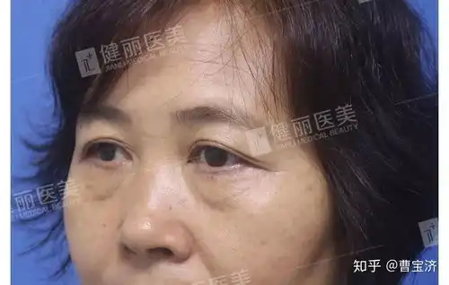 有人祛过眼袋吗效果怎么样
