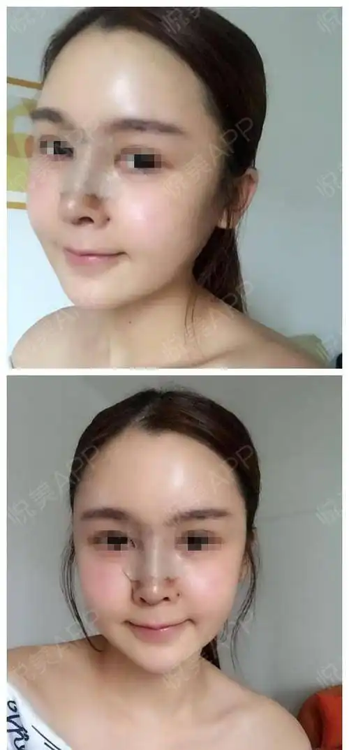 术后5天,再过两天就可以去医院拆线了哦当初听小姐...隆鼻悦美整形
