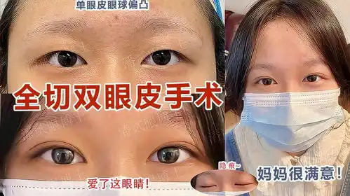 单眼皮眼球偏凸,我妈带我去广州潘贰do全切双眼皮手术啦爱了

